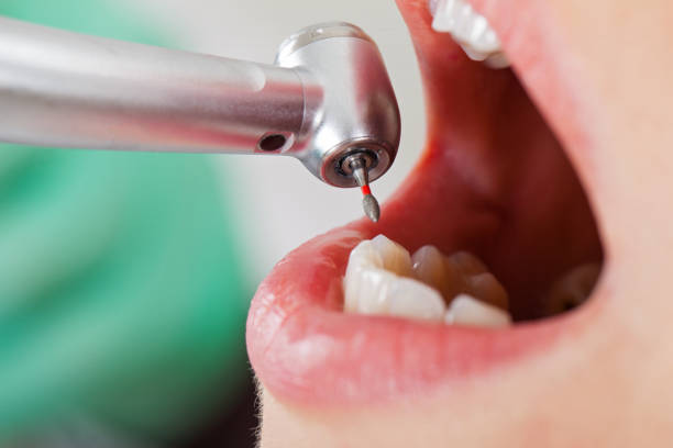 Best Emergency Dentist for Knocked-Out Tooth in Willard, OH